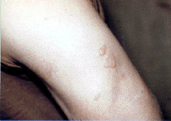 Figure 4. Private Fisher blister injury - Dr. DeClue photo