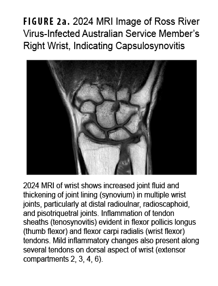 FIGURE 2a. 2024 MRI Image of Ross River Virus-Infected Australian Service Member’s Right Wrist, Indicating Capsulosynovitis  This MRI scan is paired with another MRI scan to show the effects of a Ross River virus infection on a service member’s right wrist at two points in time. The first image, from 2024, reveals significant inflammation, including excess fluid and thickening of the joint lining, as well as inflammation in the tendon sheaths. The purpose is to visually document the initial severity and lingering effects of the virus-induced arthritis.