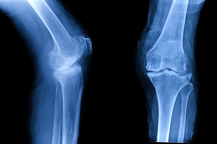 Image of Osteoarthritis (OA) knee . film x-ray AP ( anterior - posterior ) and lateral view of knee show narrow joint space, osteophyte ( spur ), subchondral sclerosis, knee joint inflammation. Photo by: iStockPhoto.