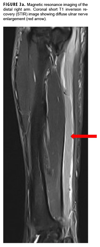 Magnetic resonance imaging of the distal right arm. Coronal short T1 inversion recovery (STIR) image showing diffuse ulnar nerve enlargement (red arrow).
