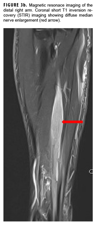 Magnetic resonace imaging of the distal right arm. Coronal short T1 inversion recovery (STIR) imaging showing diffuse median nerve enlargement (red arrow).