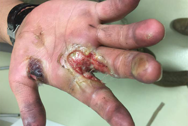 Image of Ulcer along the interspace between the patient’s right index and middle fingers. Photograph courtesy of Brooke Army Medical Center Medical Photography. Click to open a larger version of the image.