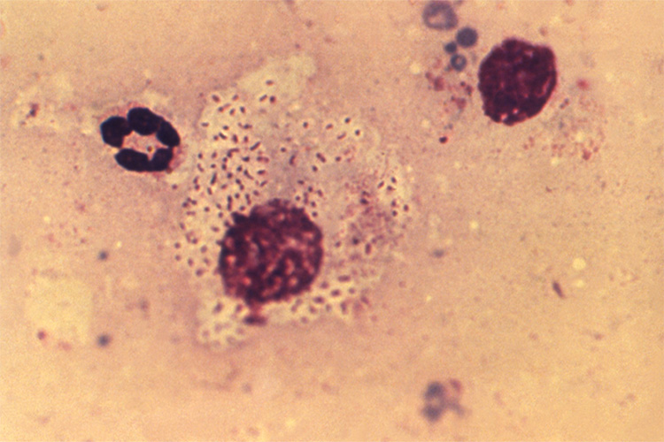 This photomicrograph of a tissue sample extracted from a lesion in the inguinal region of the female granuloma inguinale, or Donovanosis patient, depicted in PHIL 6431, revealed a white blood cell (WBC) that contained the pathognomonic finding of Donovan bodies, which were encapsulated, Gram-negative rods, representing the responsible bacterium Klebsiella granulomatis, formerly known as Calymmatobacterium granulomatis. Photo credit: CDC/ Susan Lindsley