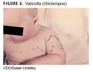 Varicella (chickenpox)