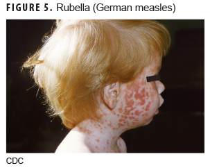 Rubella (German measles)