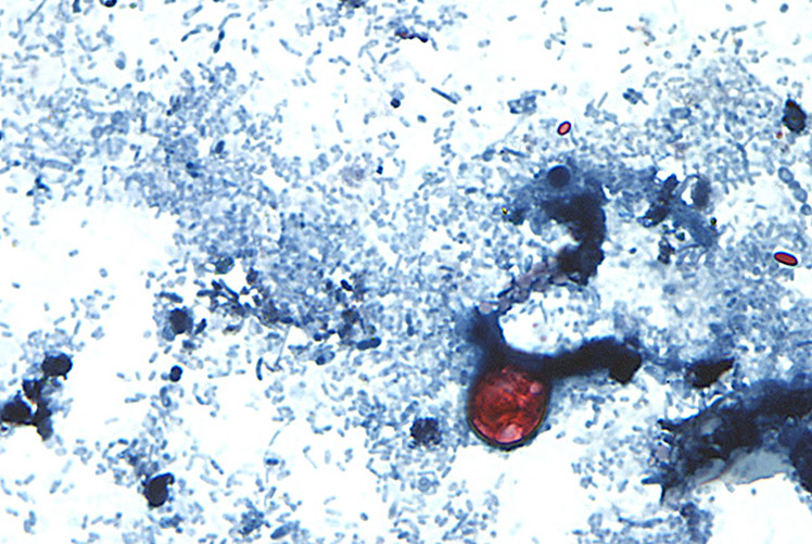 Image of Cyclosporiasis. Click to open a larger version of the image.