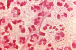 Magnified photomicrograph of a Gram-stained urethral discharge specimen