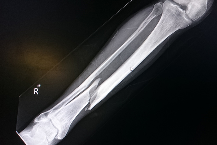 X-ray image of a fractured tibia.