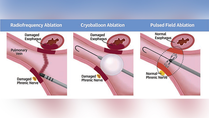 Illustration about  radiofrequency ablation.