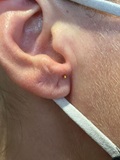Acupuncture ear