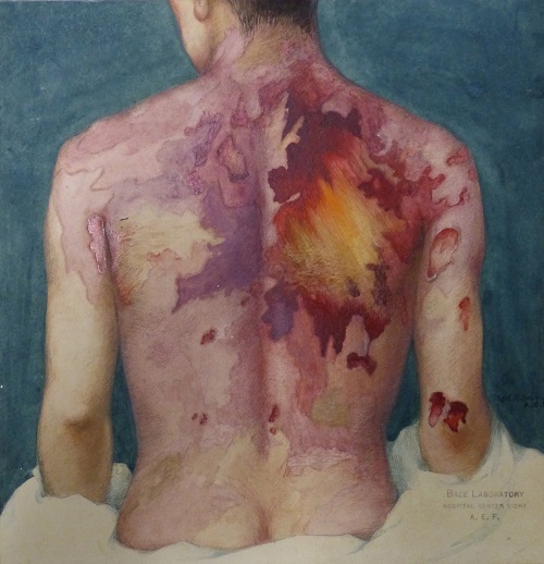 Watercolor paintings such as this one documented the traumatic effects of chemical exposure on soldiers during World War I. Color paintings were more illustrative of the nature of the injuries than black-and-white photos of that period. The Army Medical Museum dispatched illustrators to France to document injuries such as this one during and after war. This painting depicts Private Jacob Leifer of New York, New York, Company M, 16th Infantry, showing extensive first-degree mustard gas burns on Leifer’s entire back. Leifer died of bronchopneumonia due to gas poisoning and was autopsied at Base Hospital No. 15, Chaumont, France, on October 10, 1918. The artist, Sgt. Elliott R. Brainard of New York (1894-1937) was assigned to Museum Unit 1, and after the war, he worked at Walter Reed General Hospital in Washington, D.C. (Artist: Sgt. E. Brainard, watercolor, gouache, 1918) (Brainard 00002/ OHA 229.39.05, Otis Historical Archives, National Museum of Health and Medicine)