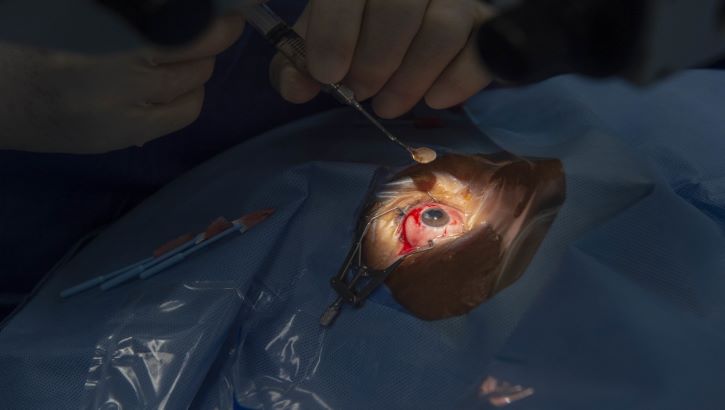 Image of A doctor performing cataract surgery .