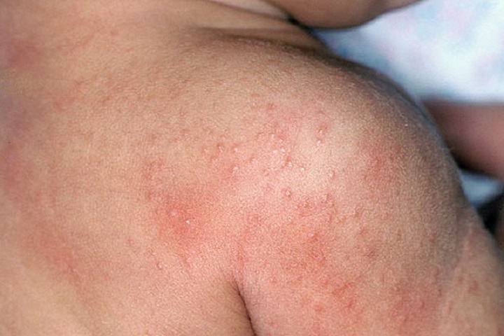 Heat rash is common in the warm summer months, but military personnel and amputees may be especially at risk. (Courtesy photo)