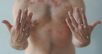Blister-like lesions are a symptom of mpox. (Photo: Image used under license from Shutterstock.com)