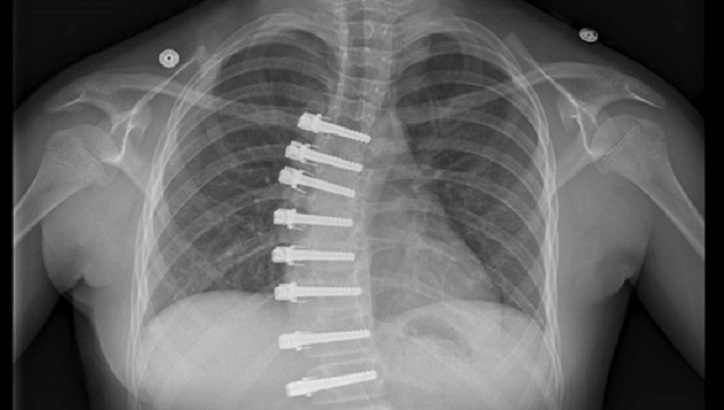 Image of X-ray of vertebral body tethering.