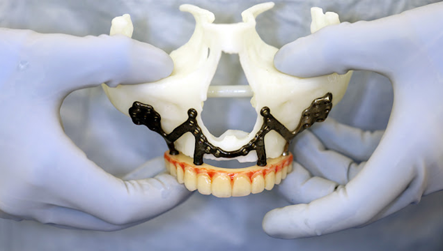 A model of a patient’s upper jaw shows the custom titanium implant and the interim fixed teeth designed to connect to it