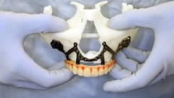 A model of a patient’s upper jaw shows the custom titanium implant and the interim fixed teeth designed to connect to it