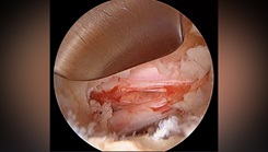 Dr. Lawless performing the procedure in the USNHO OR under the high powered laparoscope